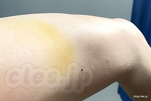 黄色くなった左腕 - I'm fully vaccinated!